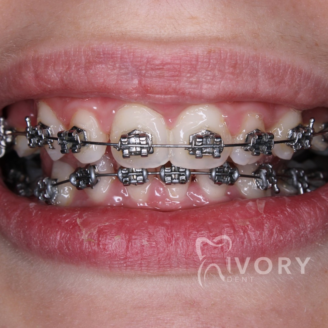 implante-dentist-dentare-kodra-diellit-15