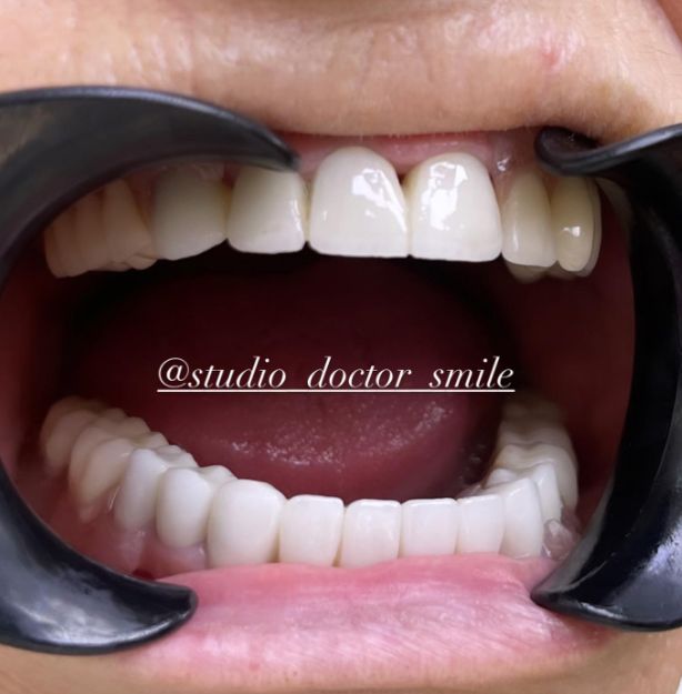 dentist-klinike-dentare-xhamllik-porcelan-14