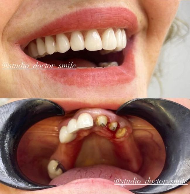 dentist-klinike-dentare-xhamllik-porcelan-15