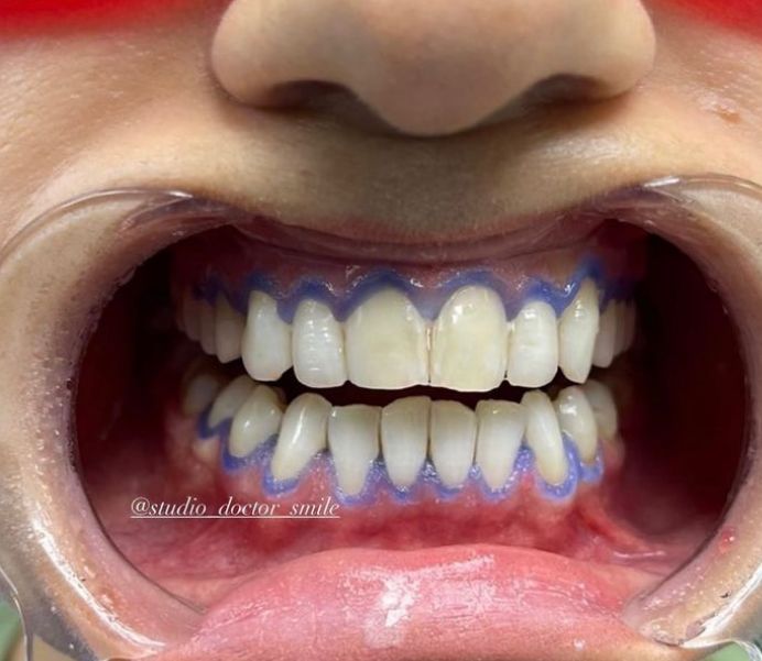 dentist-klinike-dentare-xhamllik-porcelan-16