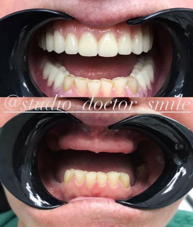 dentist-klinike-dentare-xhamllik-porcelan-191