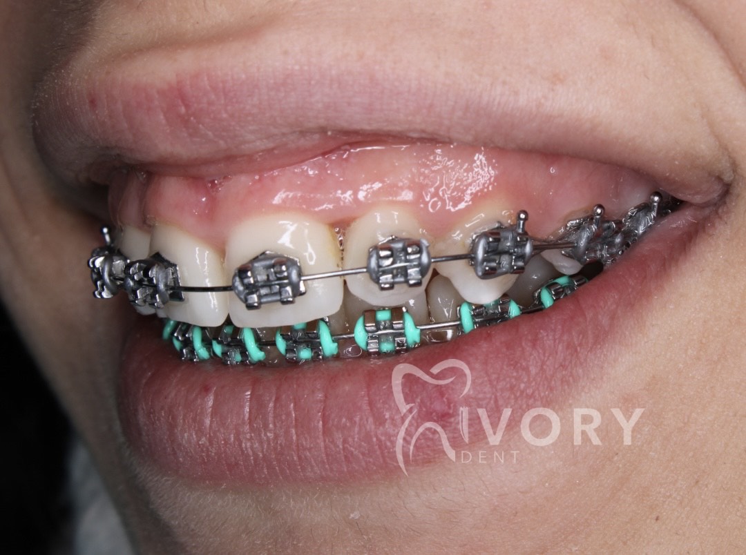 implante-dentist-dentare-kodra-diellit-17