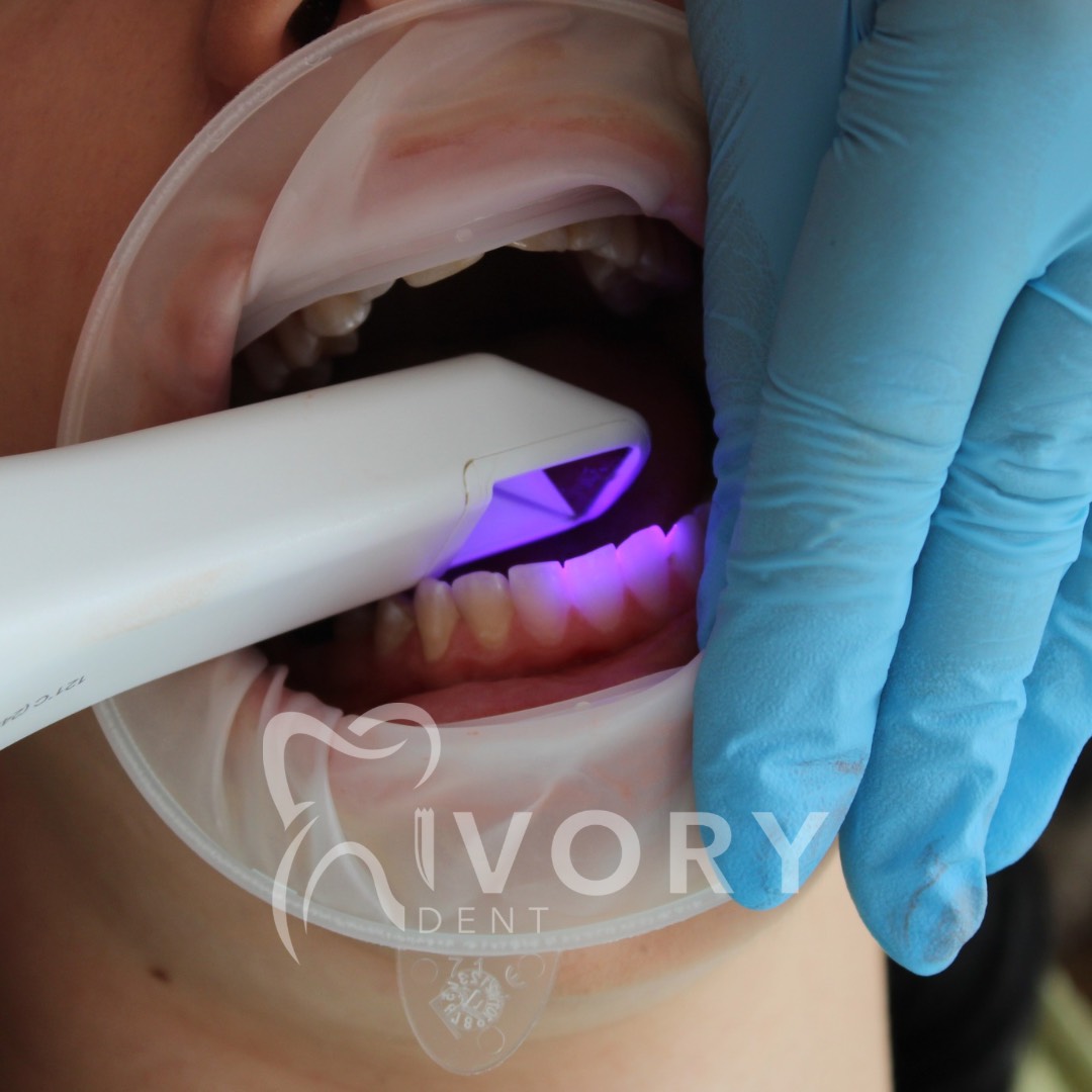 implante-dentist-dentare-kodra-diellit-19