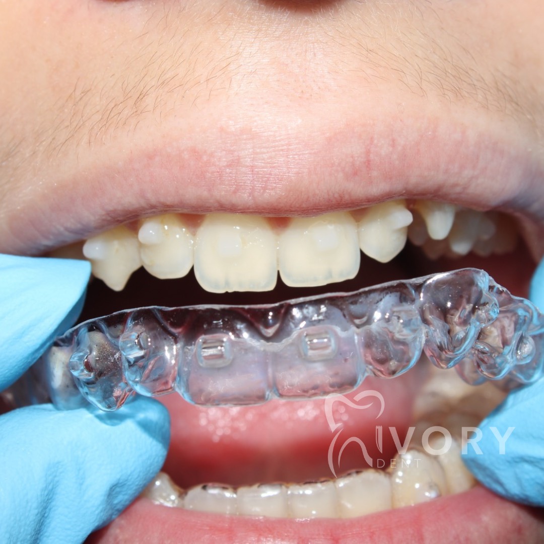implante-dentist-dentare-kodra-diellit-192