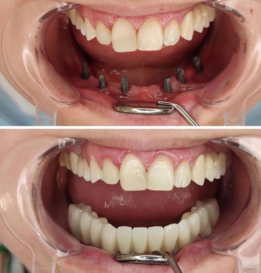 _______impianti-dentali-corone-albania-14