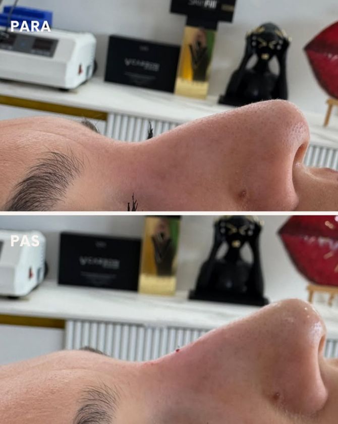 _____________filler-rimodelim-hindes-1