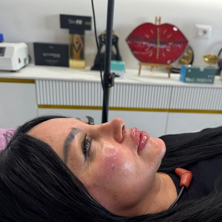 _____________filler-rimodelim-hindes-13