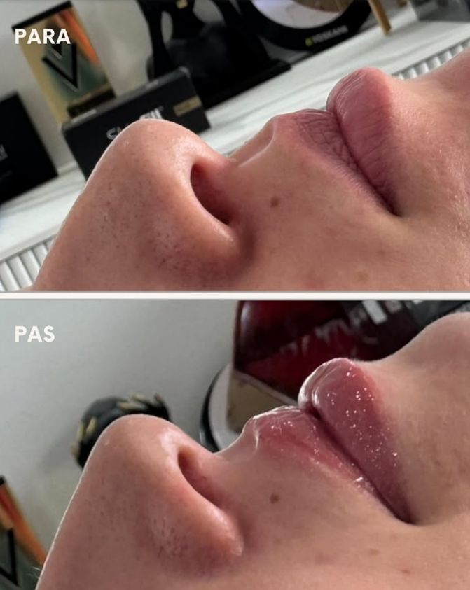 _____________filler-rimodelim-hindes-15