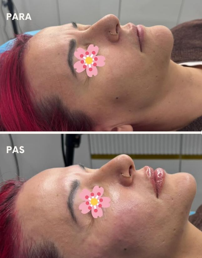 _____________filler-rimodelim-hindes-17