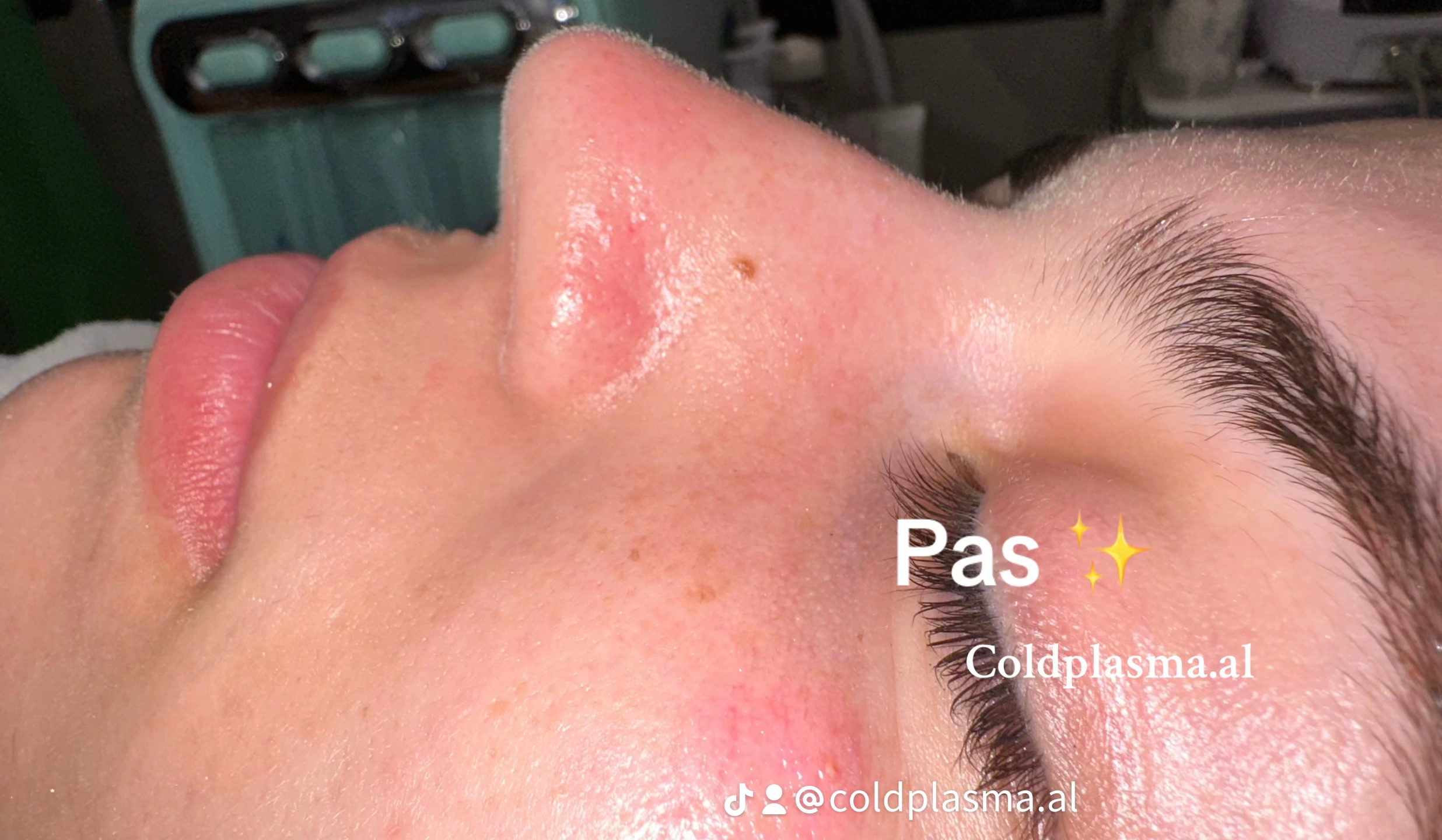 ___trajtim-me-plazem-shkoder-estetike-194