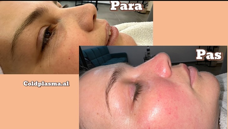 ___trajtim-me-plazem-shkoder-estetike-195