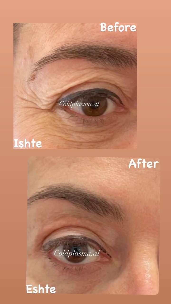 ___trajtim-me-plazem-shkoder-estetike-197