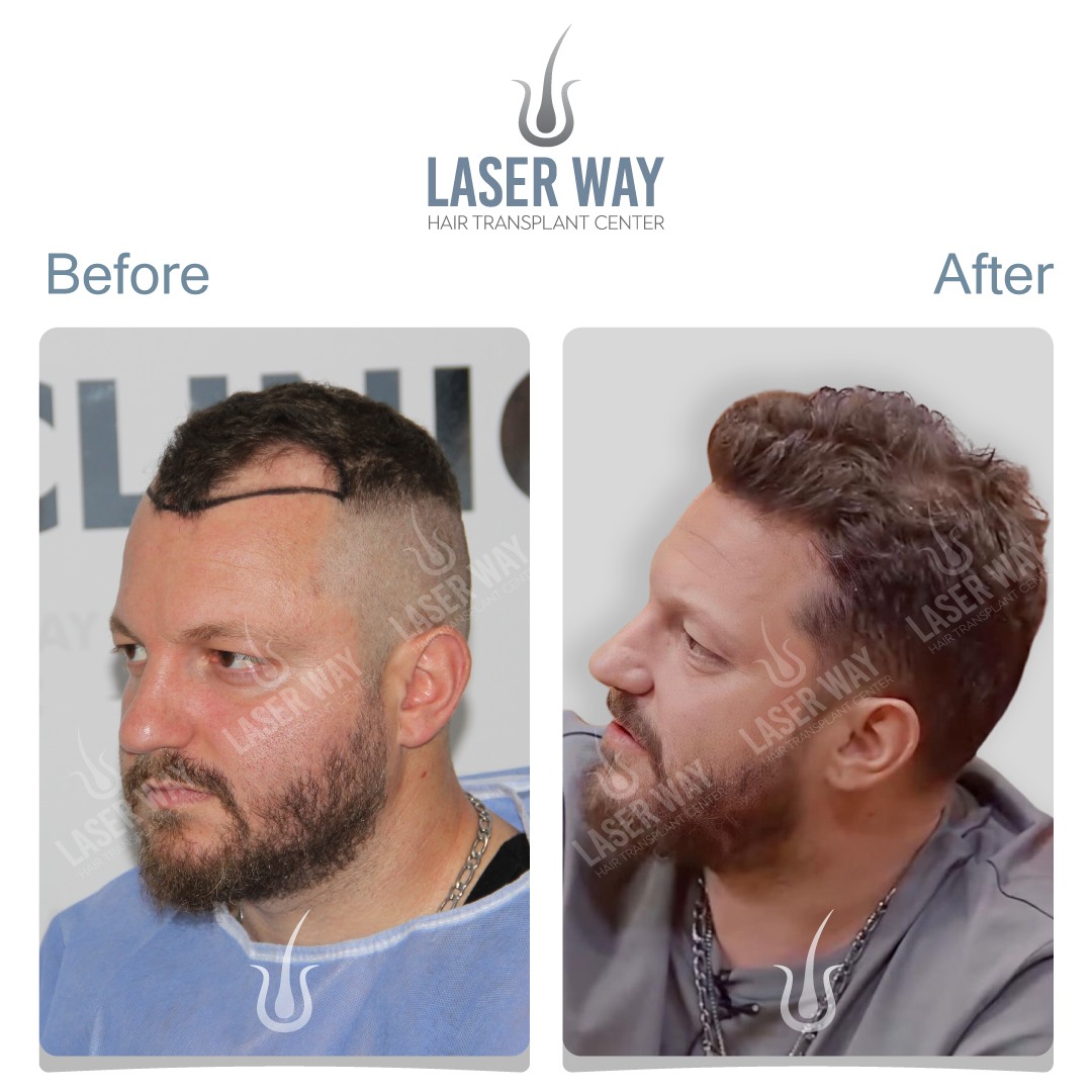 LASER WAY – KLINIKË E SPECIALIZUAR PËR TRANSPLANTIMIN E FLOKËVE NË TIRANË DHE PRISHTINË – foto 3